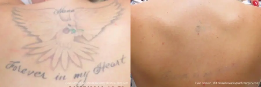 Philadelphia Tattoo Removal 8645 - Before and After 1