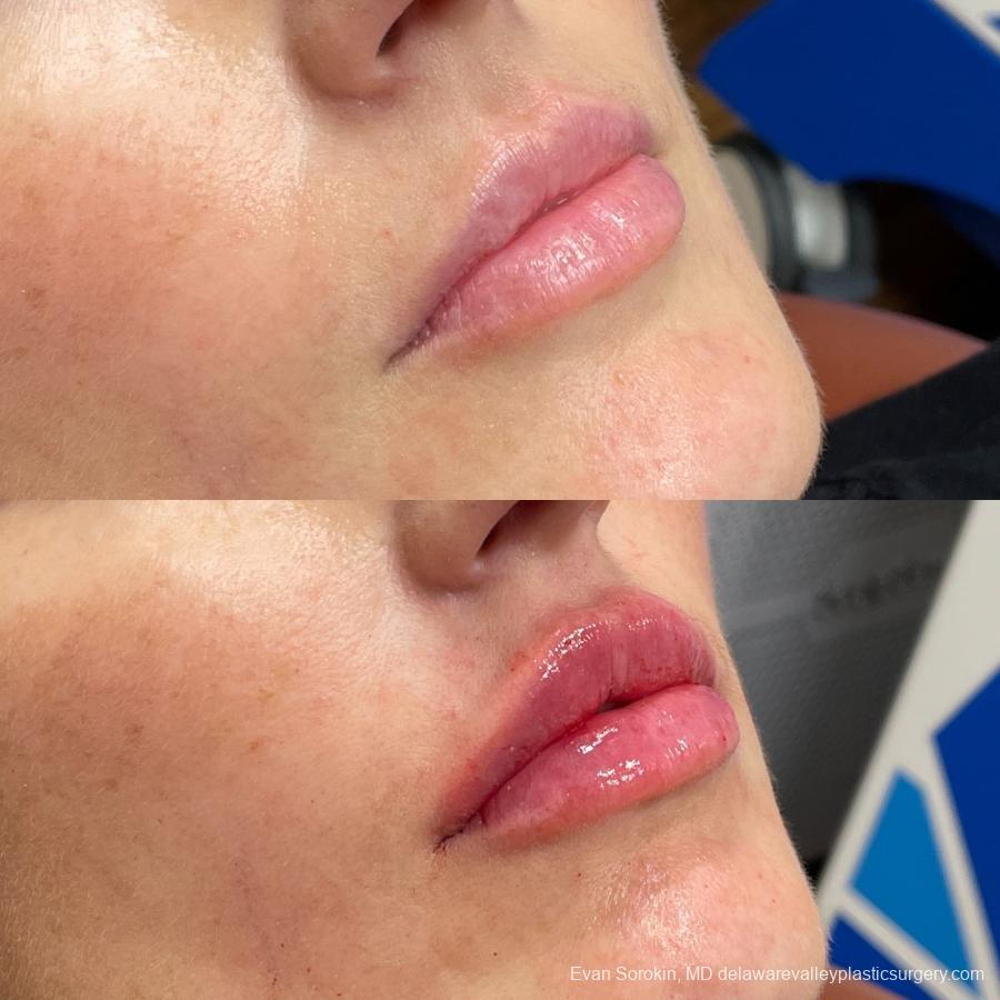 Lip Filler: Patient 2 - Before and After 2