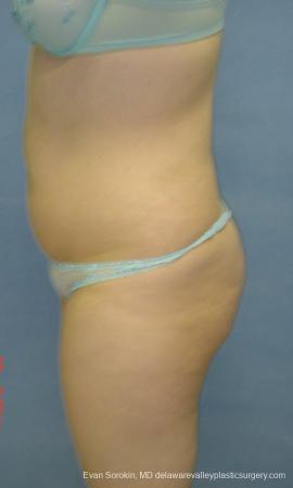 Philadelphia Liposuction 9480 - Before and After Image 3