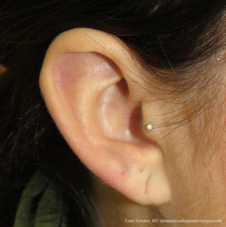 Philadelphia Earlobe Surgery 9384 - Before Image 3