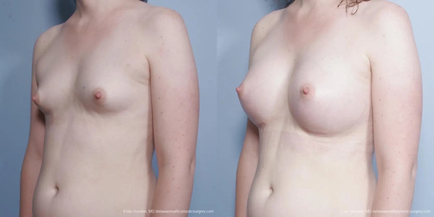 Philadelphia Top Surgery Male to Female 8642 - Before and After 3