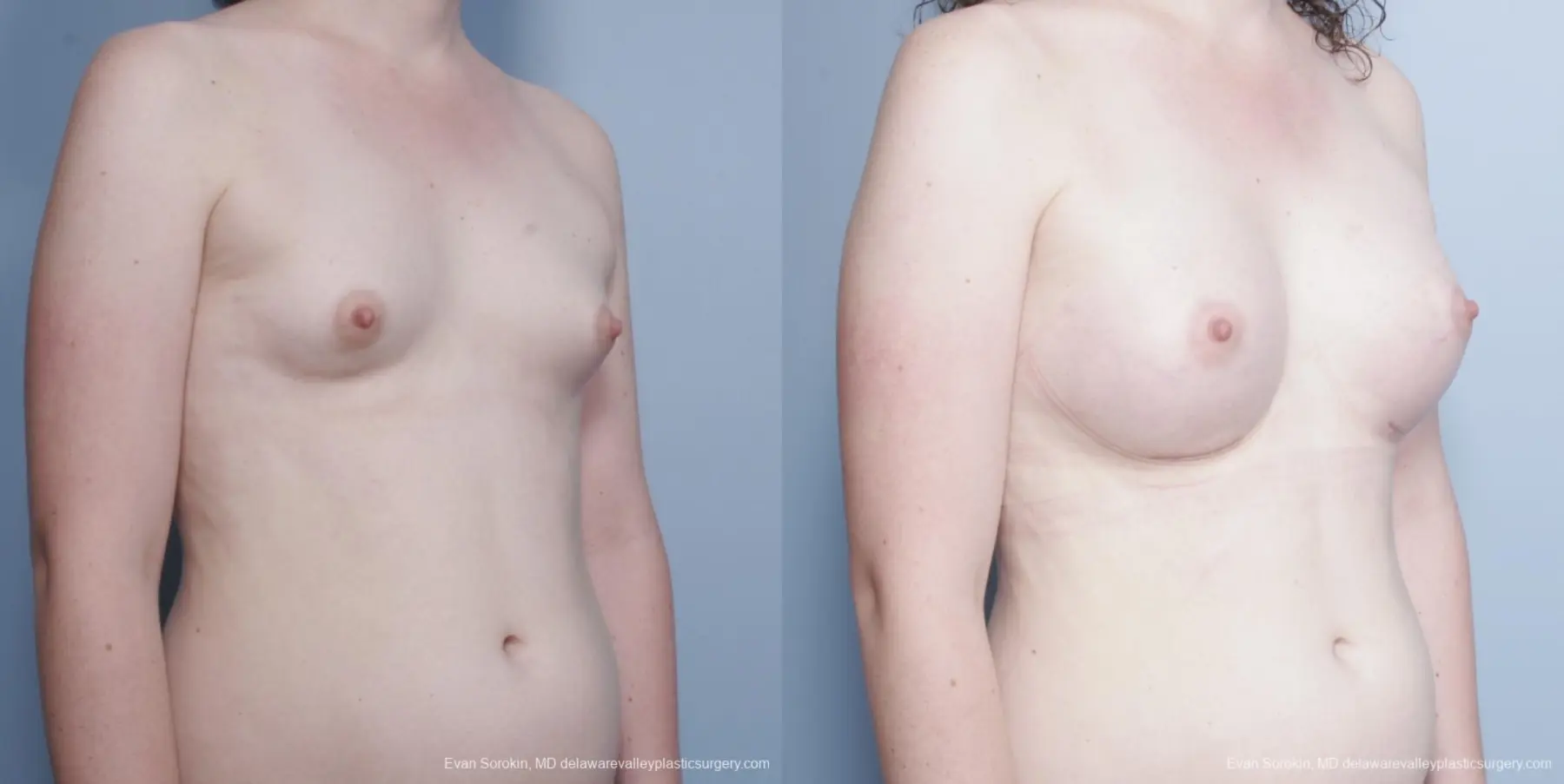 Philadelphia Top Surgery Male to Female 8642 - Before and After 2
