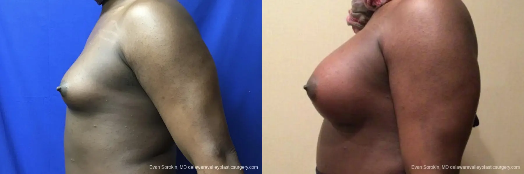 Top Surgery - Male To Female: Patient 2 - Before and After 3