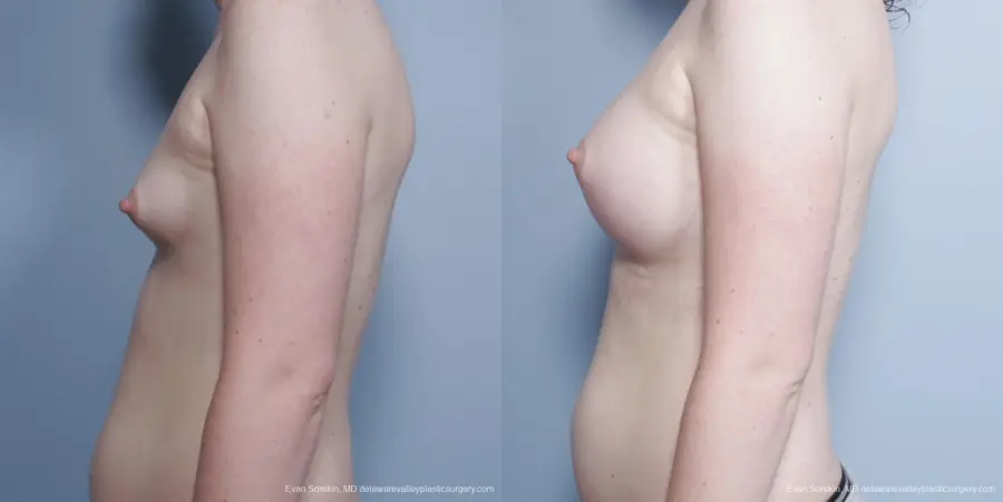Philadelphia Top Surgery Male to Female 8642 - Before and After 5