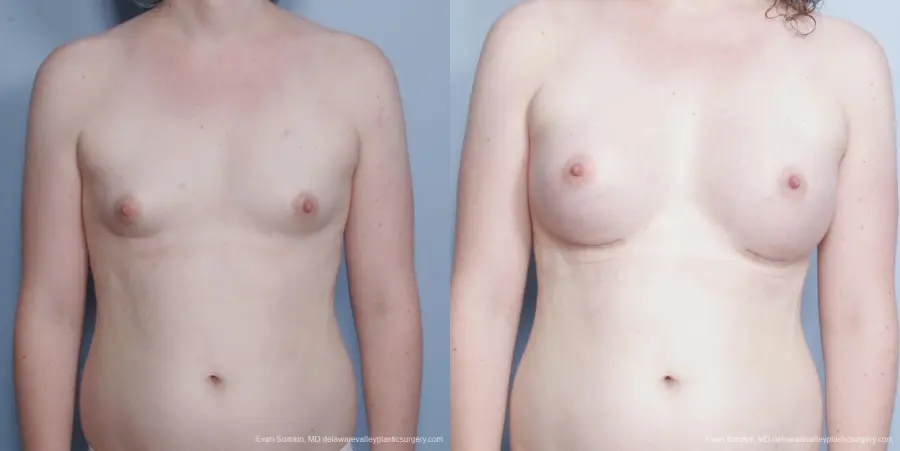 Philadelphia Top Surgery Male to Female 8642 - Before and After 1