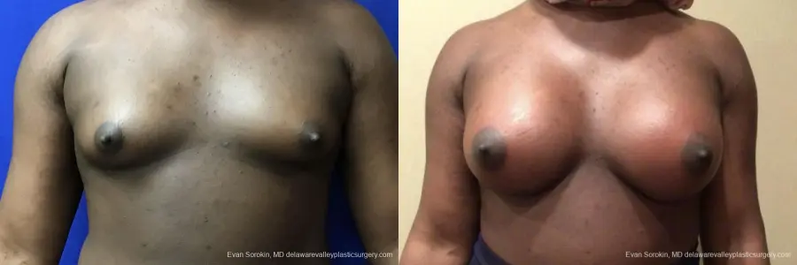 Top Surgery - Male To Female: Patient 2 - Before and After  