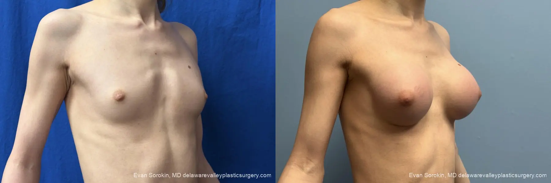 Top Surgery: Patient 3 - Before and After 2