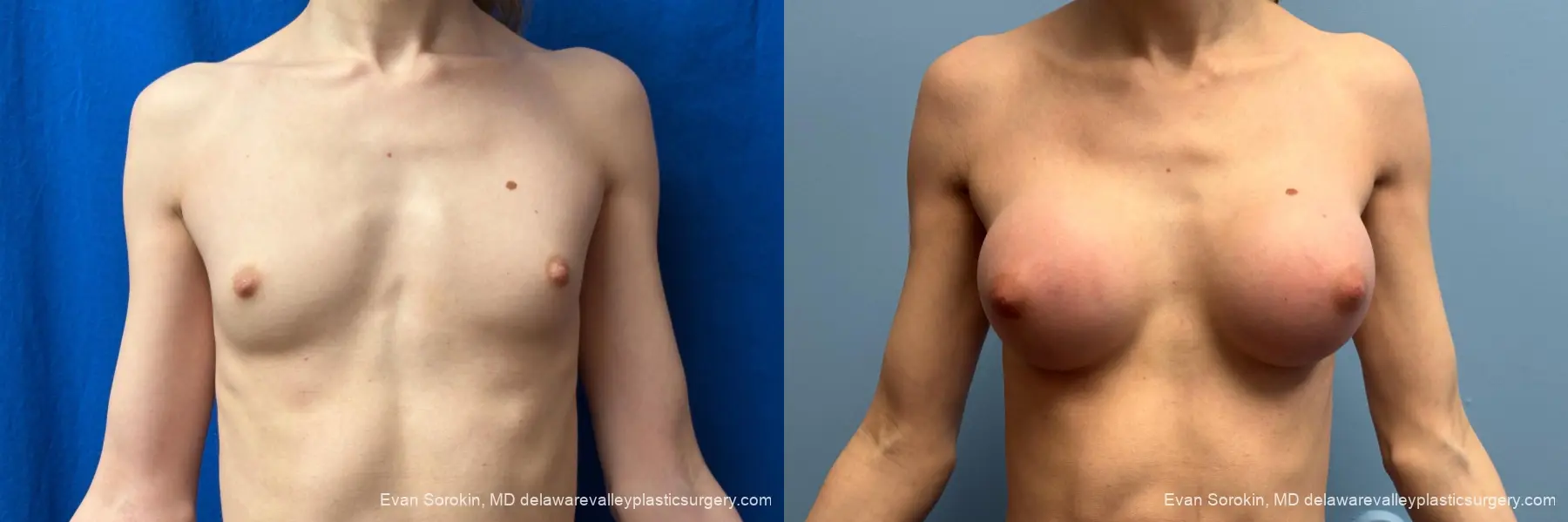 Top Surgery: Patient 3 - Before and After  