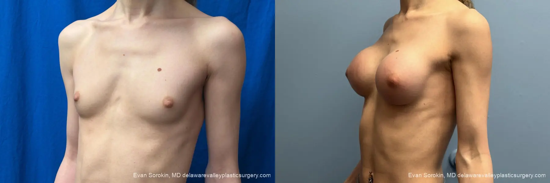 Top Surgery: Patient 3 - Before and After 4