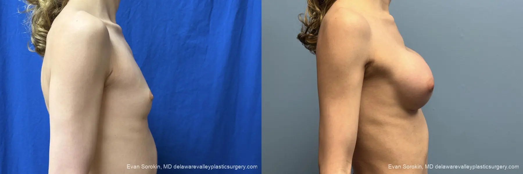 Top Surgery: Patient 3 - Before and After 3