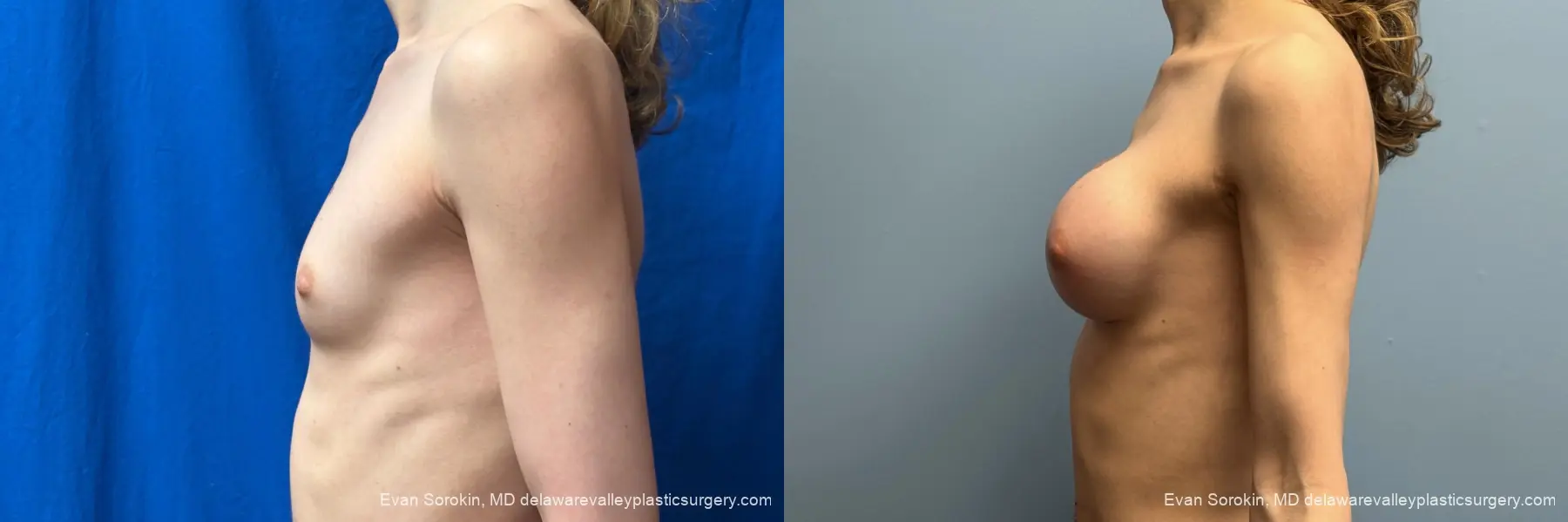 Top Surgery: Patient 3 - Before and After 5