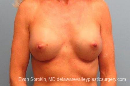Philadelphia Breast Augmentation 9415 - After Image 1