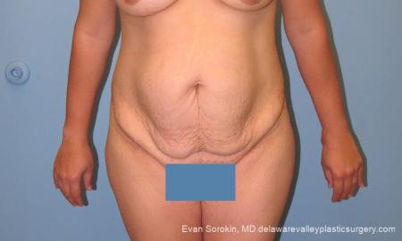 Philadelphia Abdominoplasty 10122 - Before Image 1