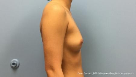 Philadelphia Breast Augmentation 13183 - Before Image 3
