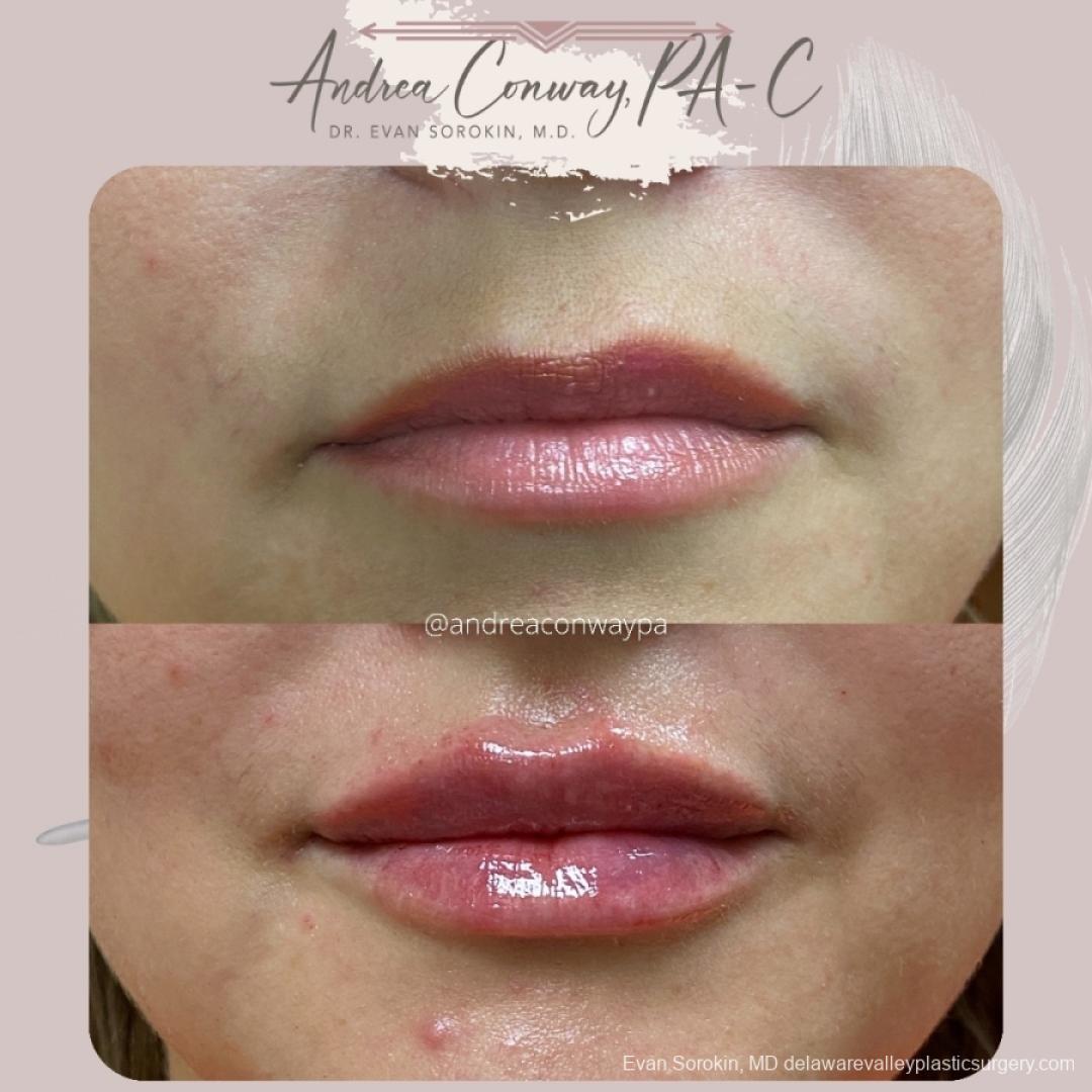 Lip Augmentation: Patient 17 - Before and After 