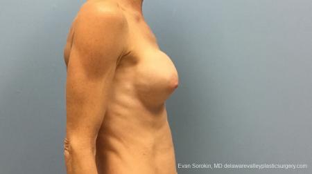Philadelphia Breast Augmentation 13182 - After Image 5