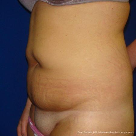 Philadelphia Liposuction 9484 - Before Image 3