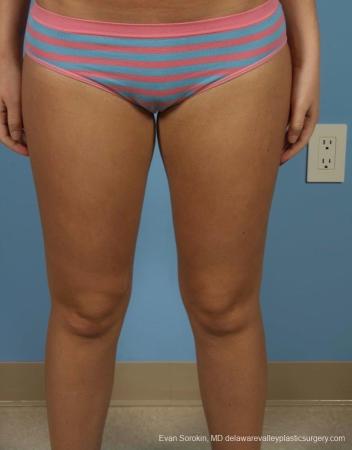 Philadelphia Liposuction 8794 - After Image 1