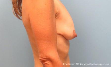 Philadelphia Breast Lift and Augmentation 9485 - Before Image 3