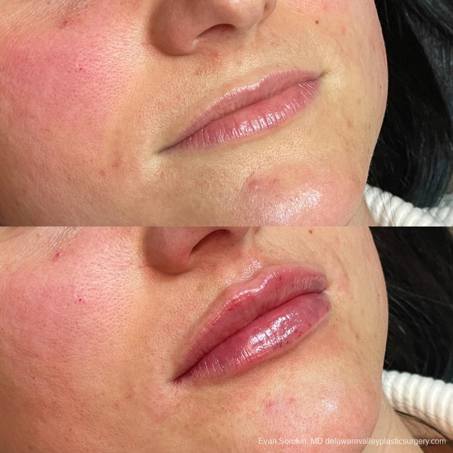 Lip Augmentation: Patient 54 - Before and After 2