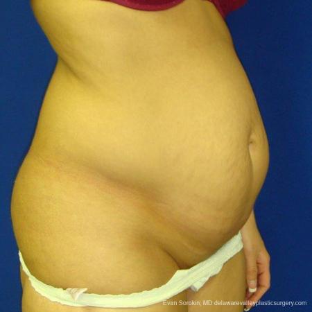 Philadelphia Abdominoplasty 9475 - Before Image 2