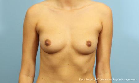 Philadelphia Breast Augmentation 9195 - Before Image 1