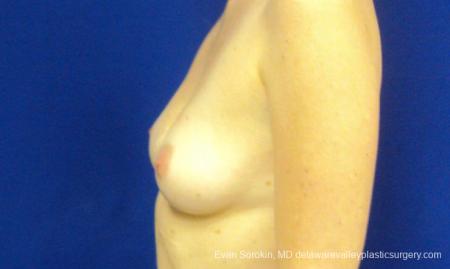 Philadelphia Breast Augmentation 8777 - Before and After Image 5