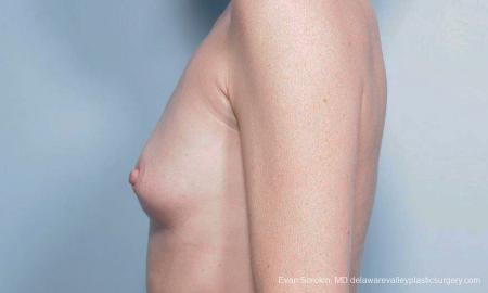Philadelphia Breast Augmentation 9459 - Before and After Image 5
