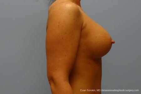 Philadelphia Breast Augmentation 8774 - After Image 4