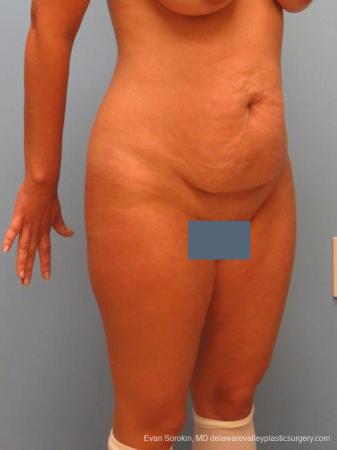 Philadelphia Abdominoplasty 9460 - Before Image 2