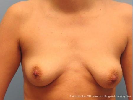 Philadelphia Breast Lift and Augmentation 10115 - Before Image 1
