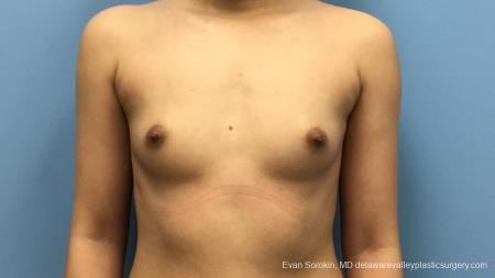 Philadelphia Breast Augmentation 13172 - Before Image 1
