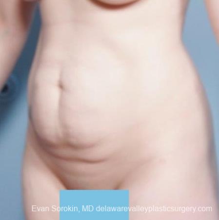 Philadelphia Abdominoplasty 8681 - Before Image 3