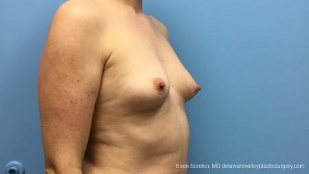 Philadelphia Breast Augmentation 13181 - Before Image 2