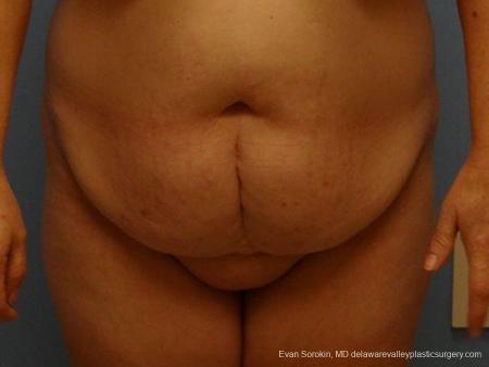 Philadelphia Abdominoplasty 9467 - Before Image 1
