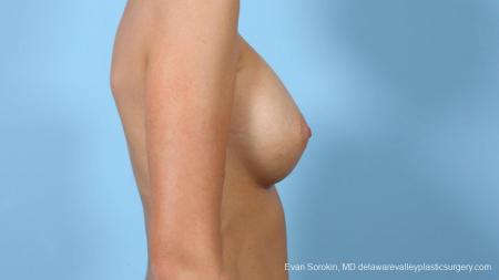 Philadelphia Breast Augmentation 9292 - After Image 5