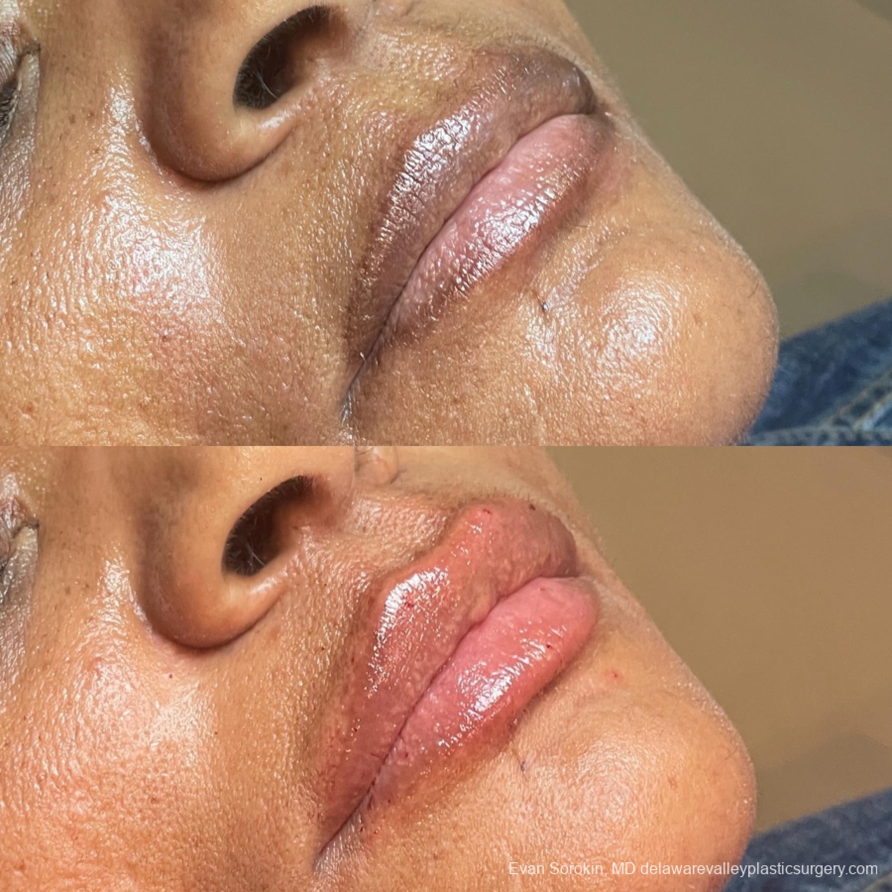 Lip Augmentation: Patient 65 - Before and After 2