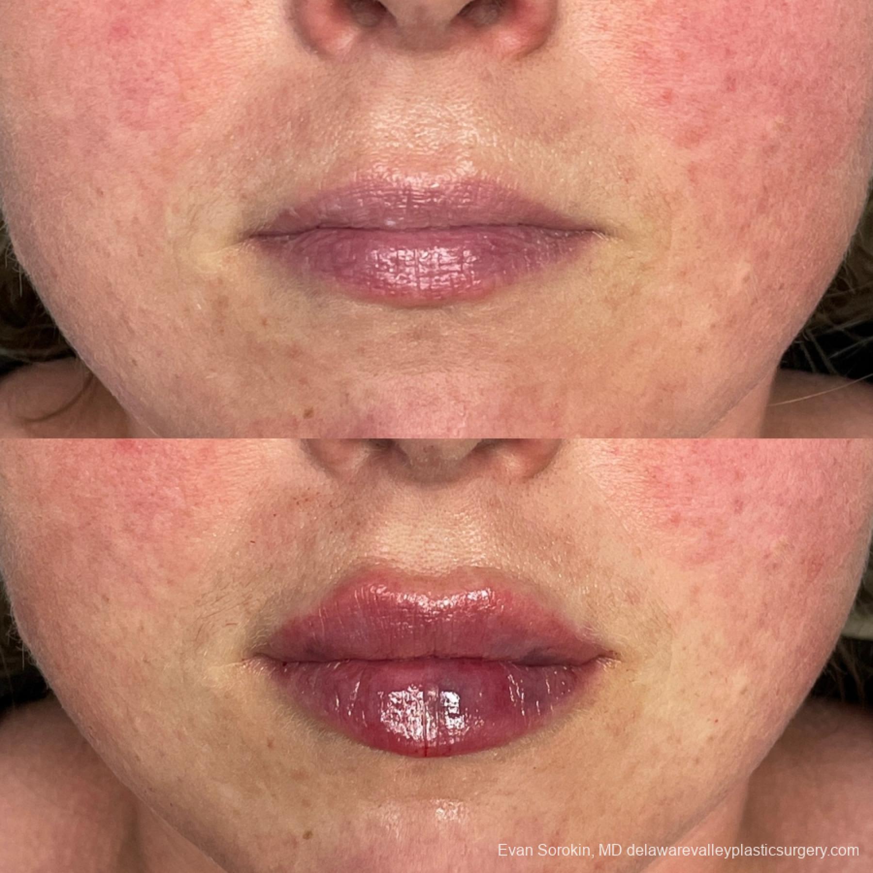 Lip Filler: Patient 67 - Before and After 1