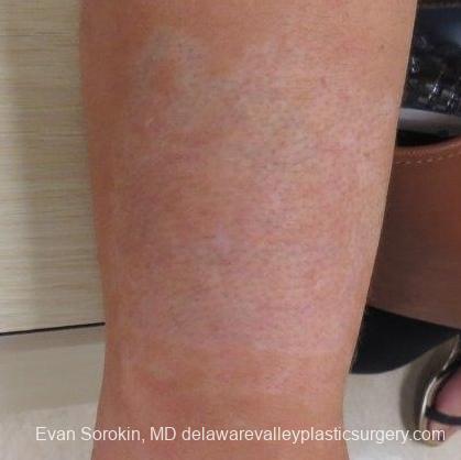 Philadelphia Tattoo Removal 8647 - After Image 1