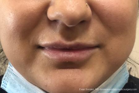 Lip Augmentation: Patient 14 - Before Image 1