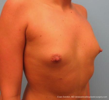 Philadelphia Breast Augmentation 8826 - Before Image 2