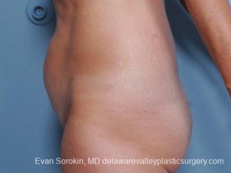 Philadelphia Abdominoplasty 8682 - Before and After Image 5