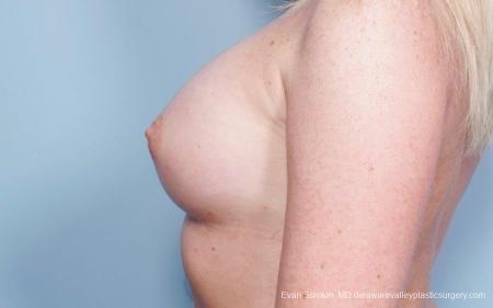 Philadelphia Breast Augmentation 8778 - After Image 5