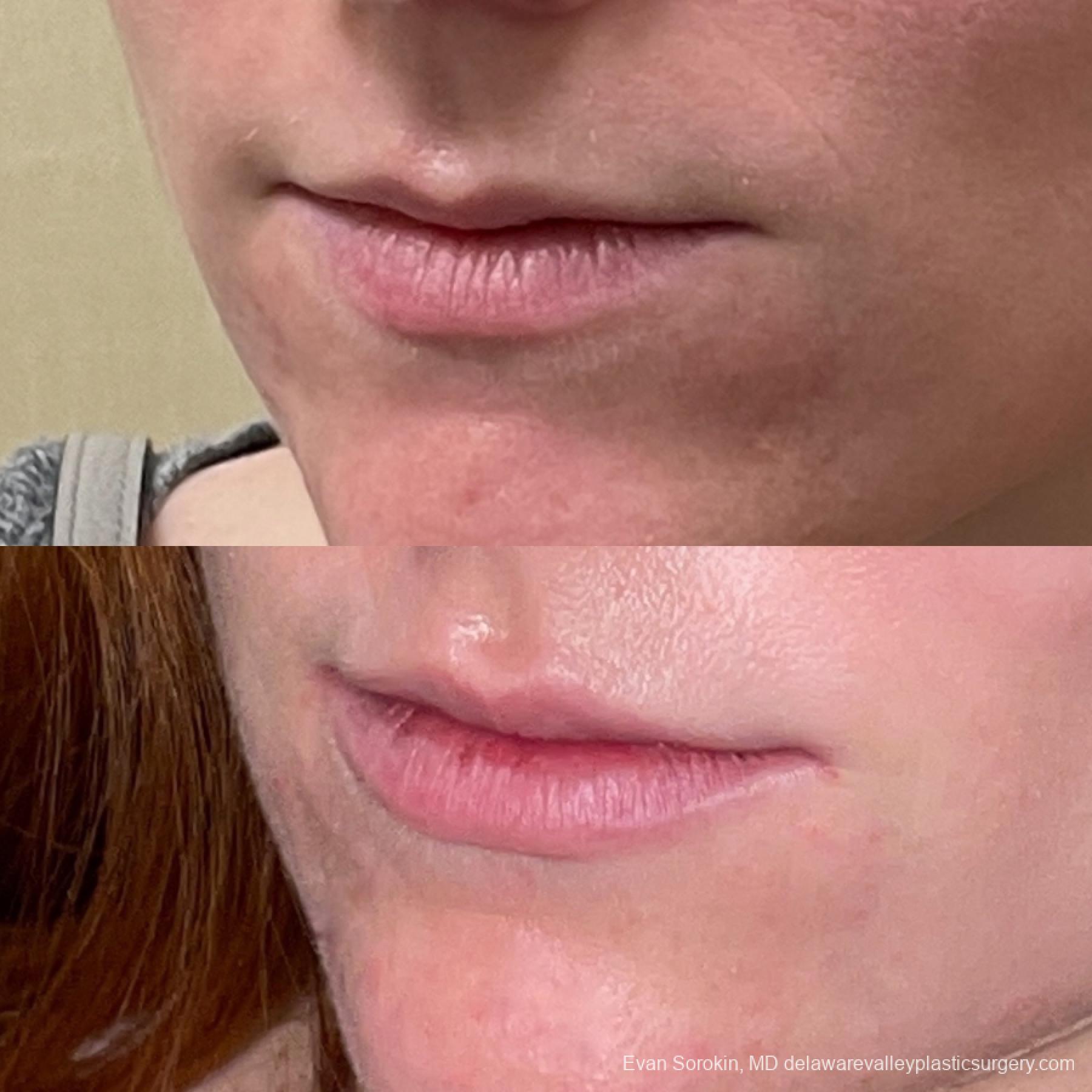 Lip Filler: Patient 31 - Before and After 3