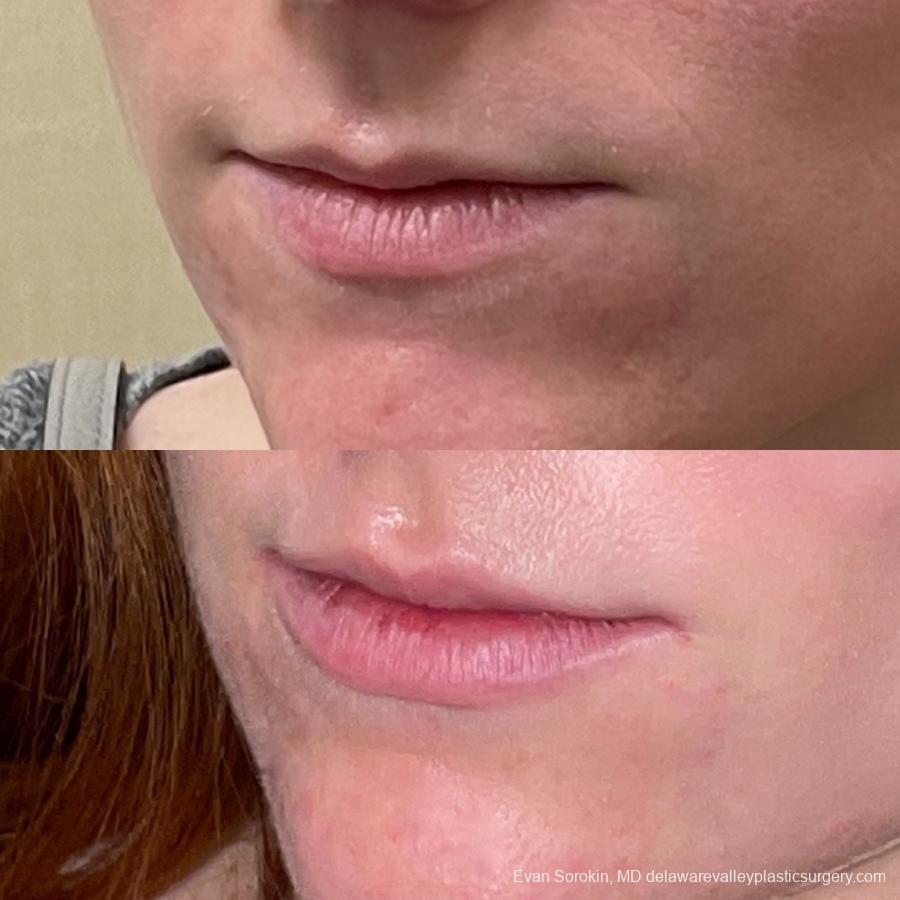 Lip Filler: Patient 31 - Before and After 3