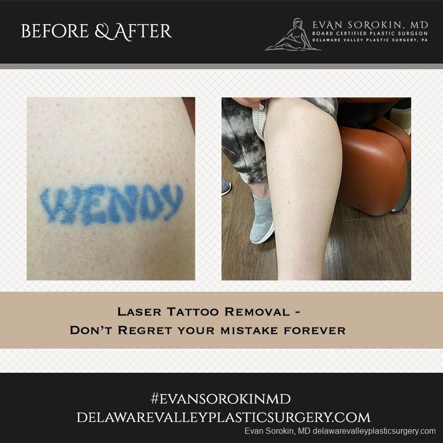 Tattoo Removal: Patient 2 - Before and After
