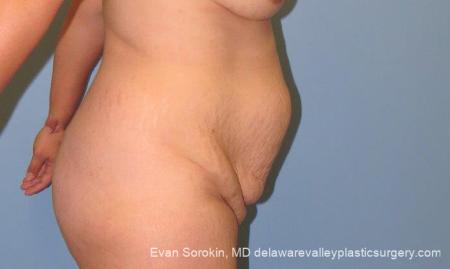 Philadelphia Abdominoplasty 10122 - Before Image 3