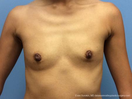 Philadelphia Breast Augmentation 13071 - Before Image 1
