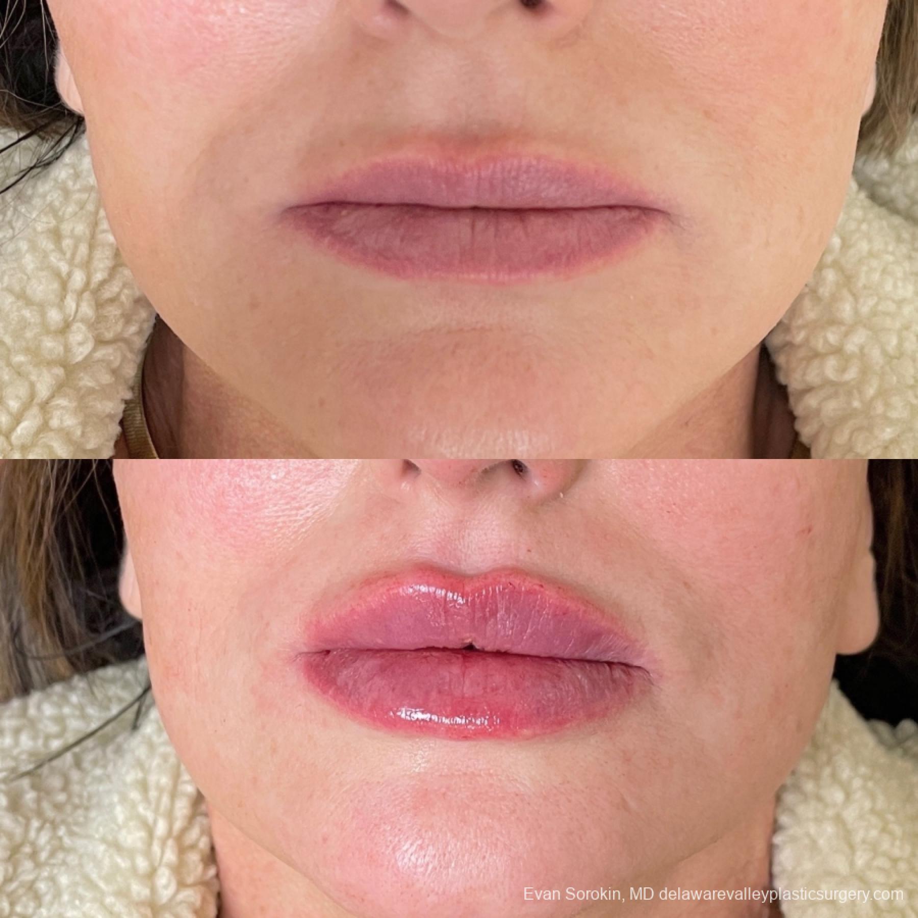 Lip Augmentation: Patient 61 - Before and After 1