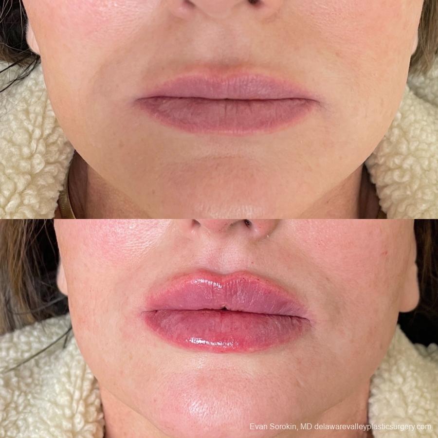 Lip Augmentation: Patient 63 - Before and After 1